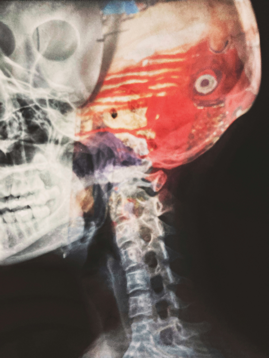 An x-ray of a human head and neck with brain visible