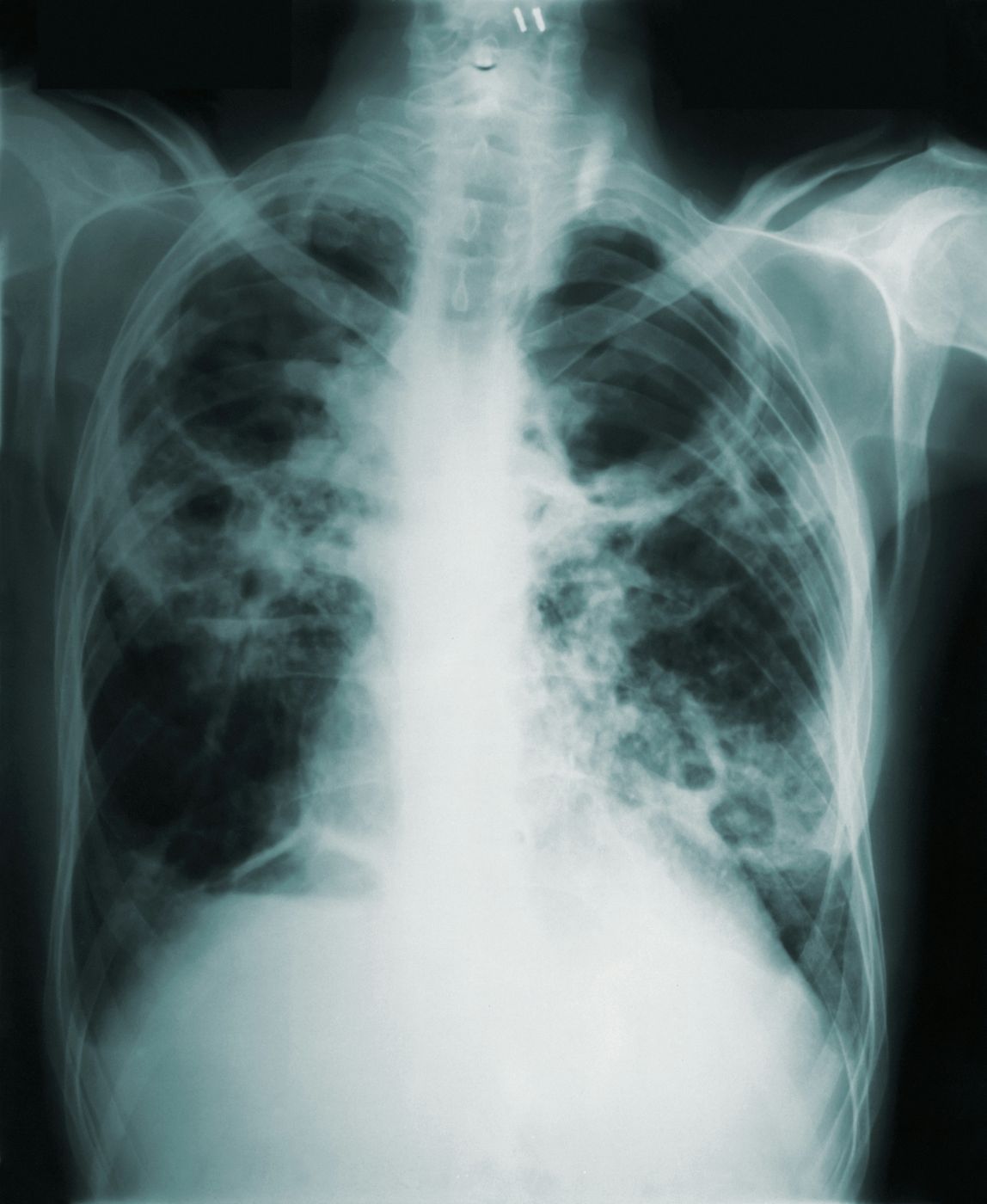 An e-ray of a person's chest