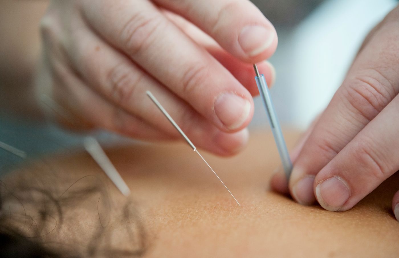 Close up of someone having acupuncture 